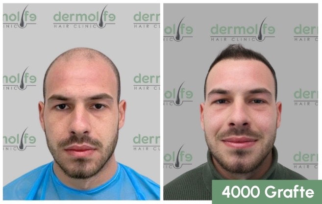 transplanti i flokut me metoden DHI