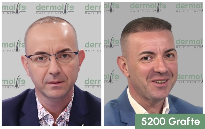 Mbjellje floku tirane