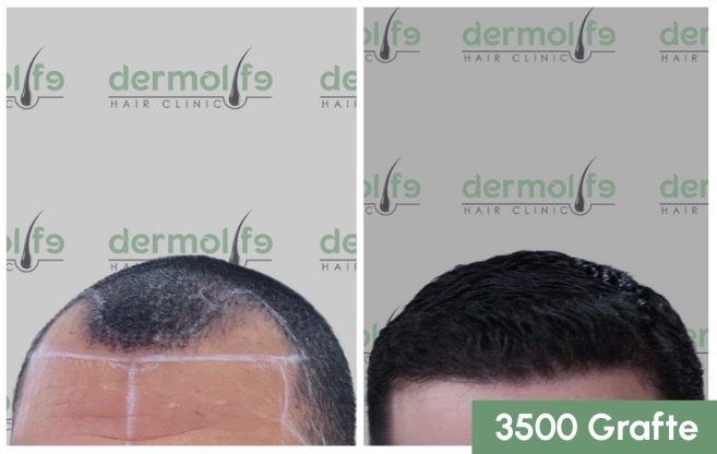 Mbjellja e flokut ne tirane